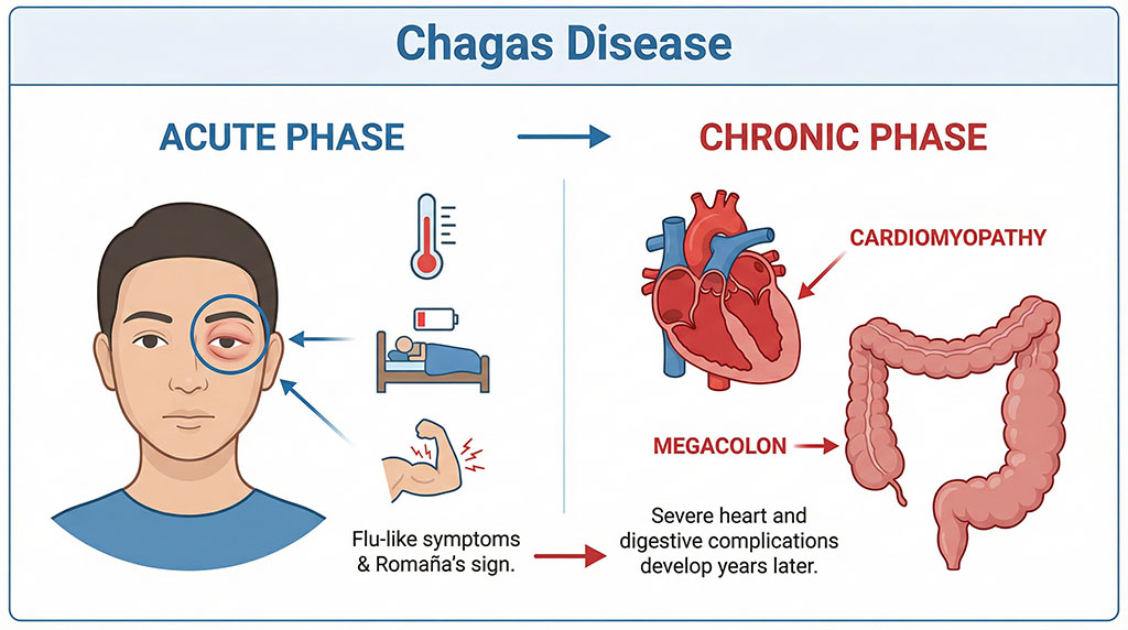 An illustration showing the acute and chronic phases of Chagas disease, including symptoms like Romaña's sign and long-term heart complications.